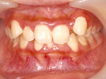 ケースNo.2 治療前 (1).jpg